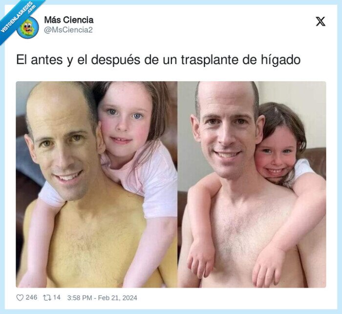 trasplante,después,hígado,antes