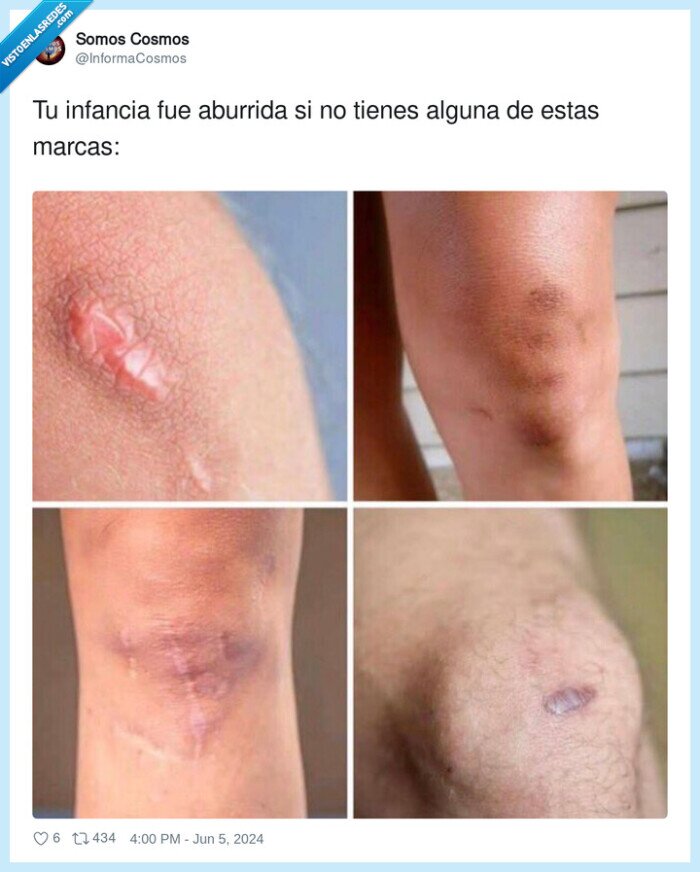 infancia,aburrida,cicatrices,marcas,rodillas