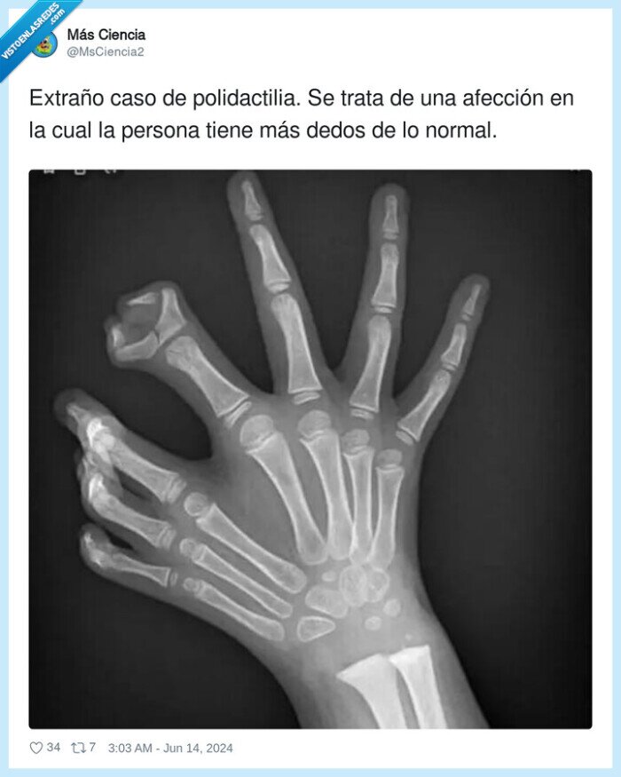 polidactilia,afección,extraño,dedos