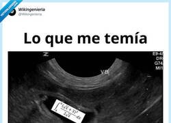 Enlace a Cálculos en la vesícula, por @Wikingenieria