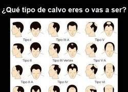 Enlace a Tipos de alopecia...
