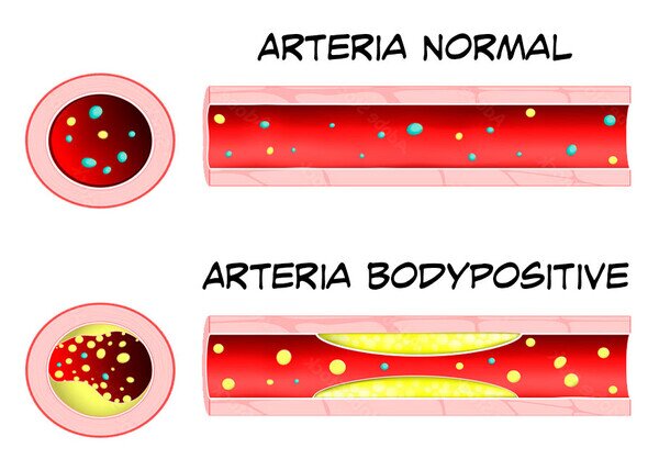 arteria,bodypositive,grasa