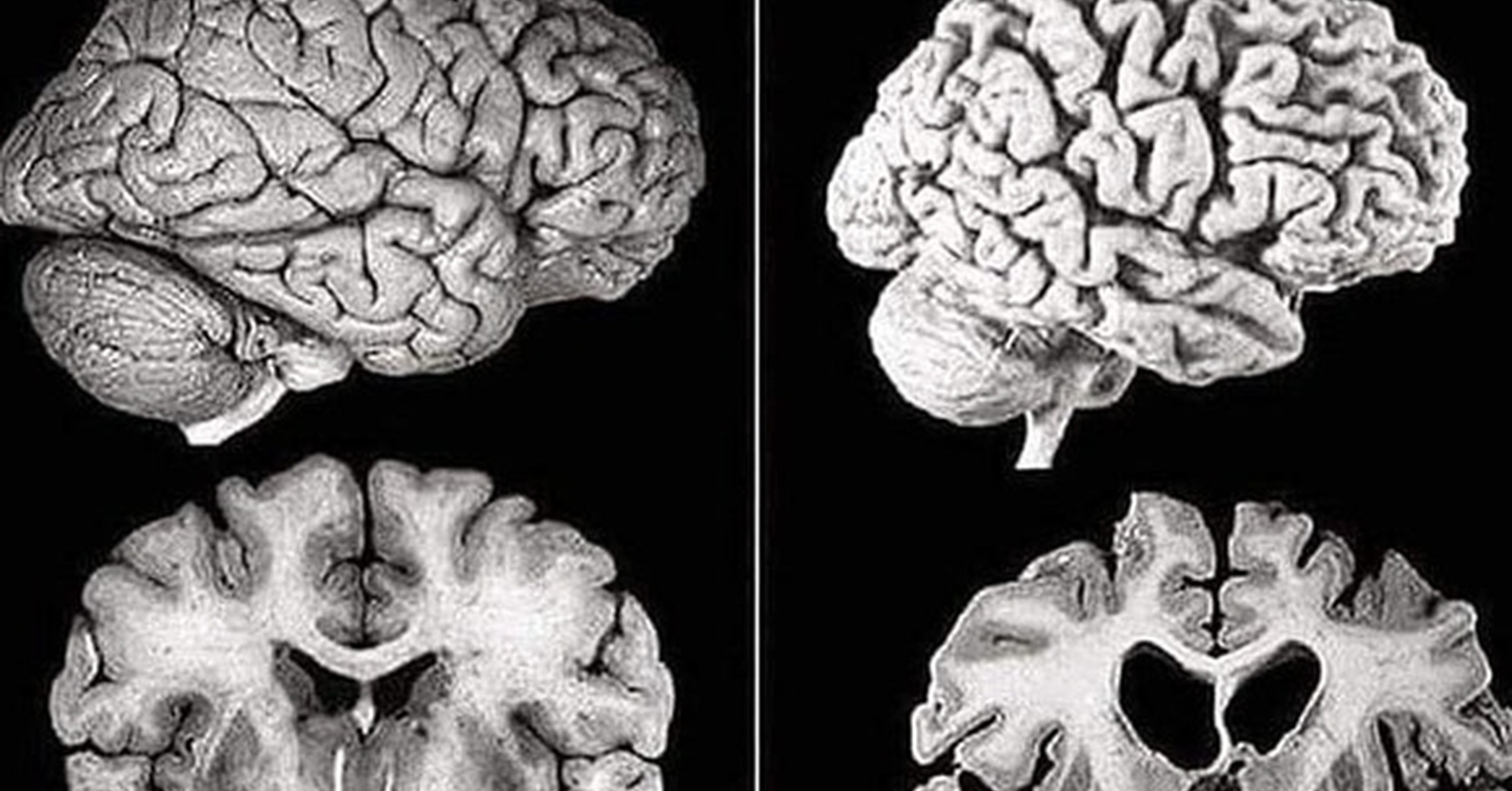 Признаки атрофии головного мозга. Болезнь Альцгеймера. Мозг при болезни Альцгеймера. Атрофические болезни мозга.