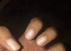 Enlace a Los efectos de la quimio en las uñas