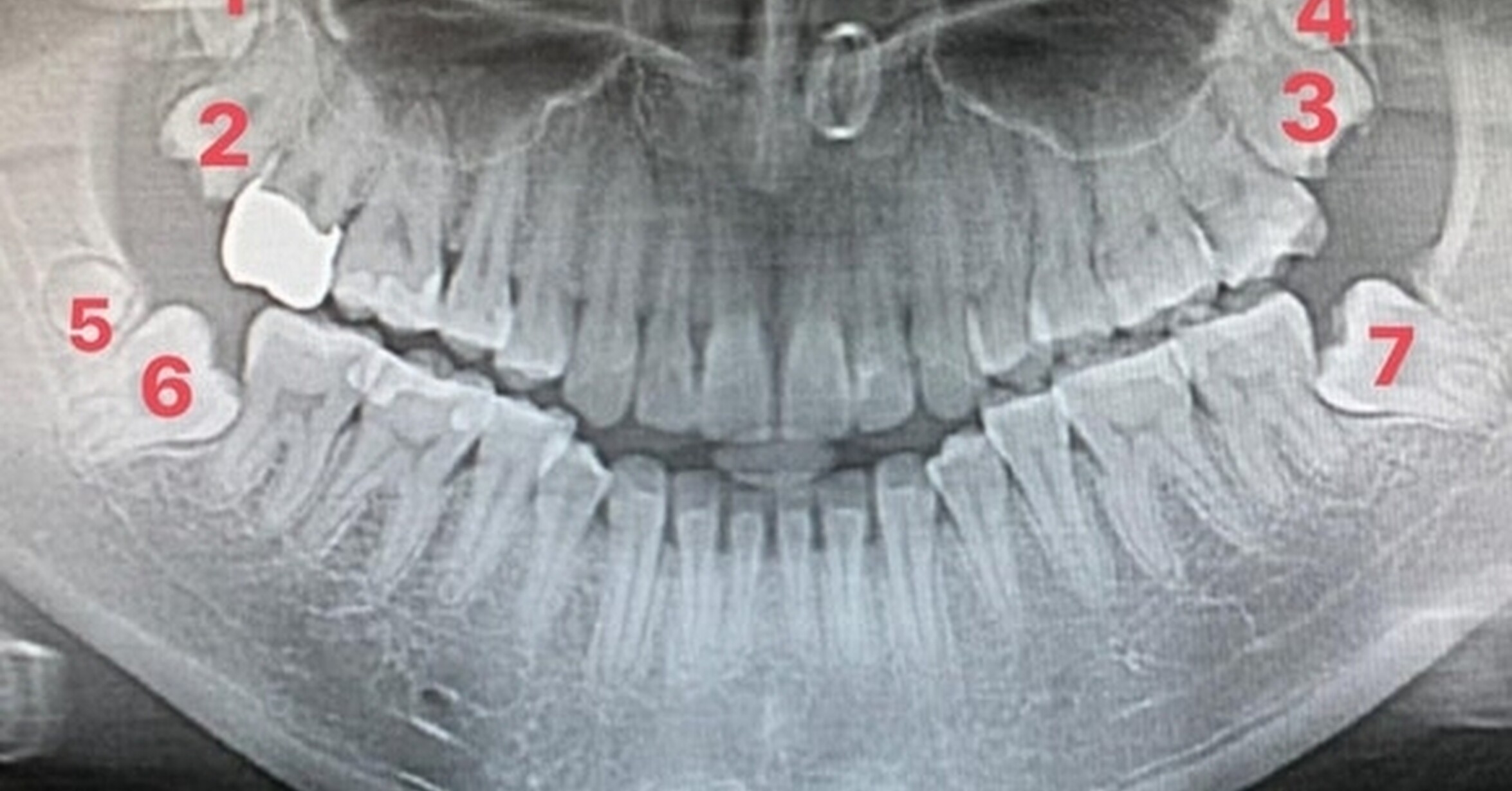 ¡Cuánta razón! / Muelas del juicio extra