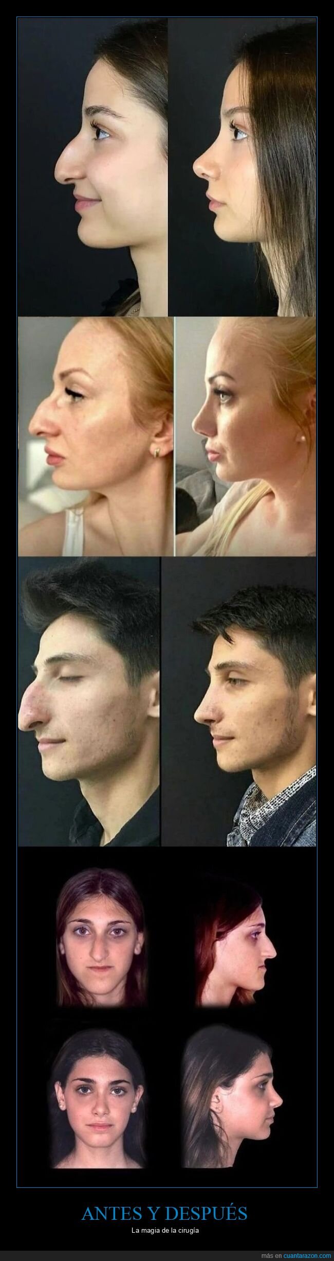 cirugía,nariz,antes,después