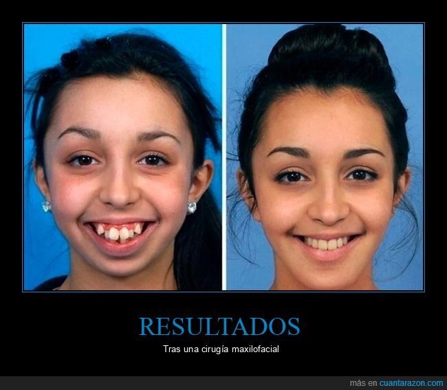 boca,antes,después,cirugía maxilofacial