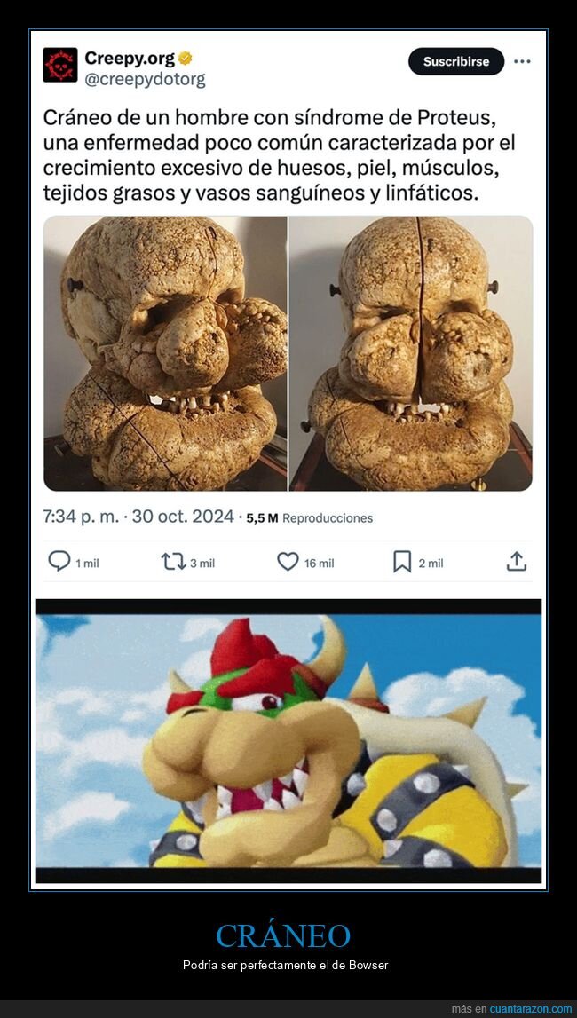 cráneo,síndrome de proteus,bowser