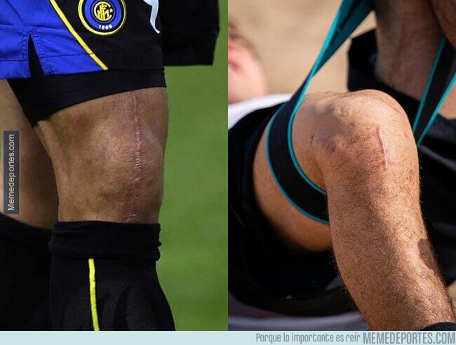 1202763 - Evolución de la cicatriz que deja una reconstrucción de ligamentos.