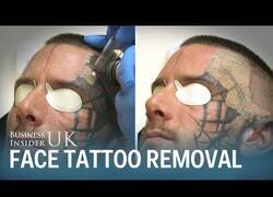 Enlace a Eliminando un tatuaje en la cara con láser