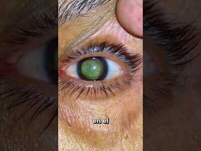 Hialosis asteoridea, la condición ocular que hace que tus ojos parezcan galaxias