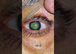 Enlace a Hialosis asteoridea, la condición ocular que hace que tus ojos parezcan galaxias